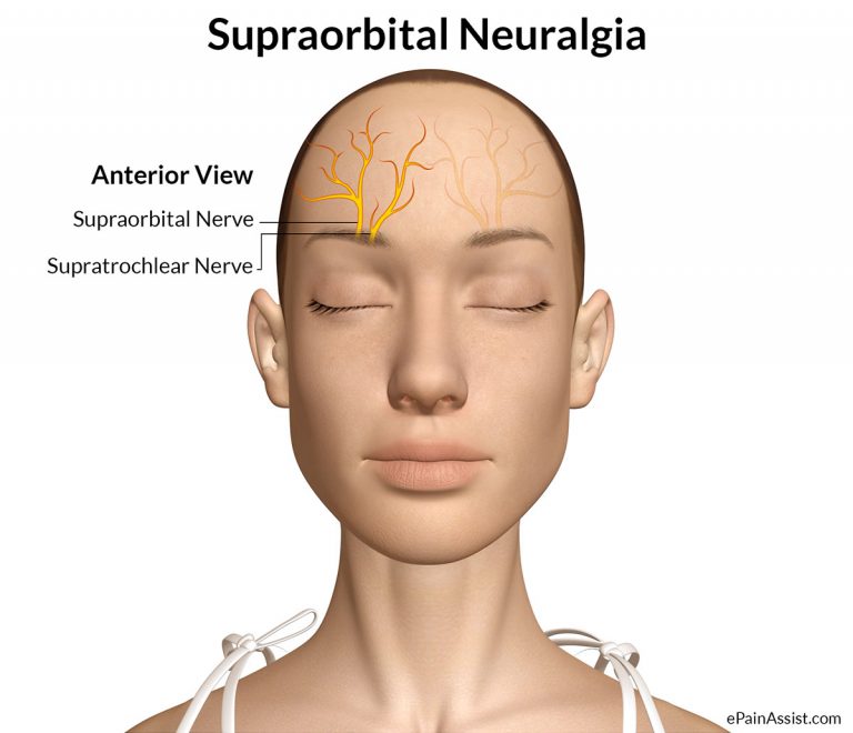 Supraorbital Neuralgia or Goggle Headache: Etiology, Symptoms, Treatment- Painkillers