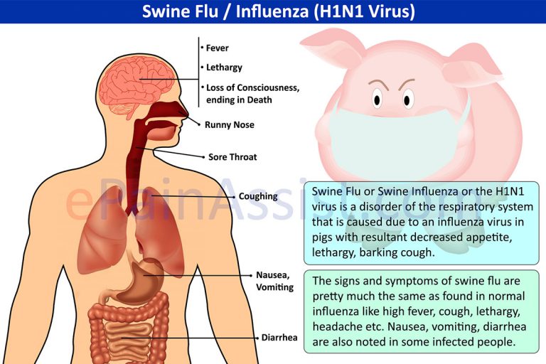 Swine Flu or Swine Influenza (H1N1 Virus): Symptoms, Signs, Diagnosis, Treatment, Risk Factors