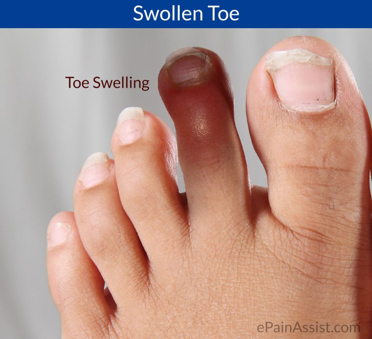 Swollen Toe or Toe Swelling: Causes, Symptoms, Treatment