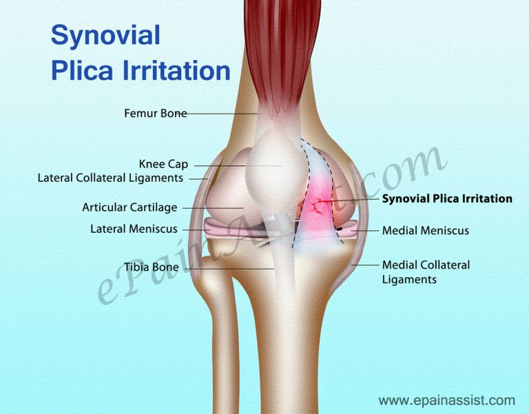 Synovial Plica Irritation: Symptoms, Prevention, Treatment- PT, NSAIDs, Surgery