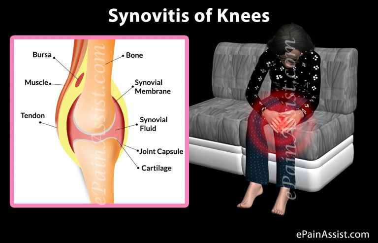 Synovitis of Knees, Hips, Ankles, Shoulders, Wrists, Jaw Joint