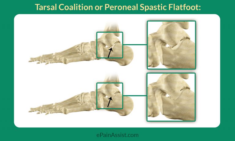 Tarsal Coalition or Peroneal Spastic Flatfoot: Signs, Causes, Diagnosis, Treatment- Surgery