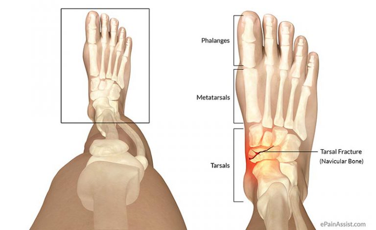 Tarsal Fracture: Signs, Symptoms, Treatment- Cast, NSAIDs, Surgery, Rehab, Exercises