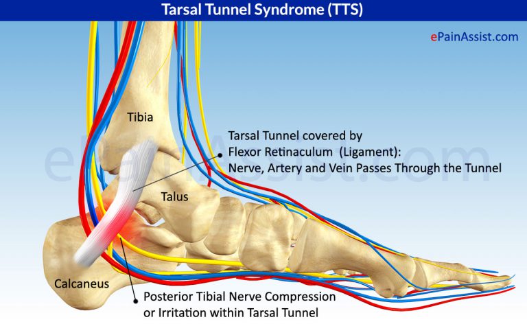 What is Tarsal Tunnel Syndrome (TTS) or Posterior Tibial Neuralgia: Treatment, Exercises, Causes, Symptoms