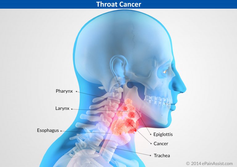 Throat Cancer: Types, Causes, Signs, Symptoms, Treatment- Surgery, Targeted Drug Therapy