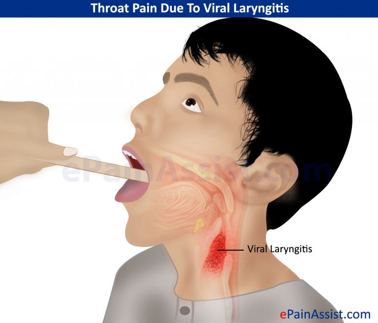 Throat Pain Due To Viral Laryngitis: Types, Symptoms, Prevention, Diagnosis, Treatment