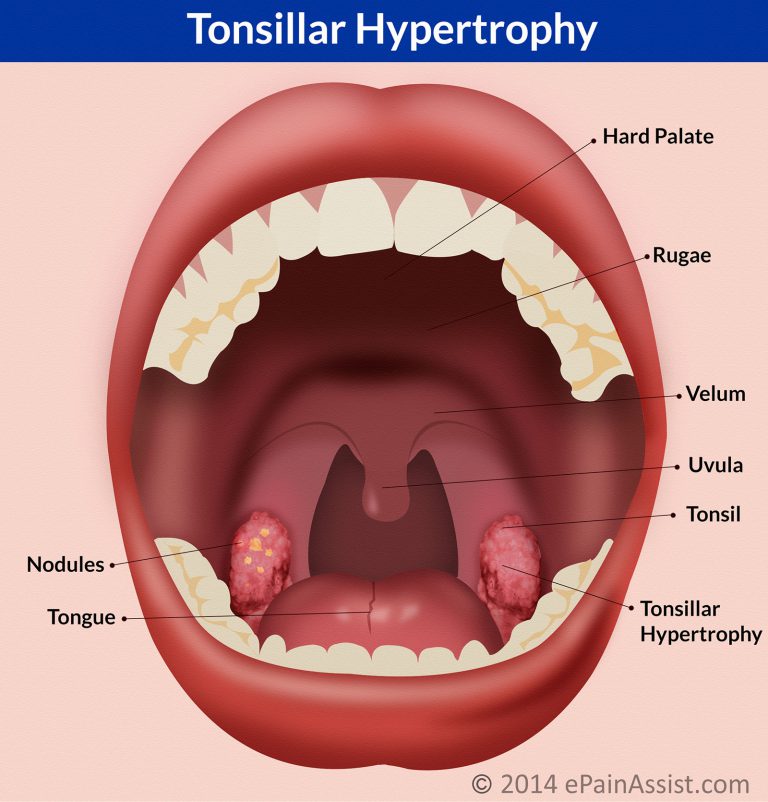 Tonsillar Hypertrophy: Causes, Symptoms, Treatment- Antibiotics, Tonsillectomy Surgery