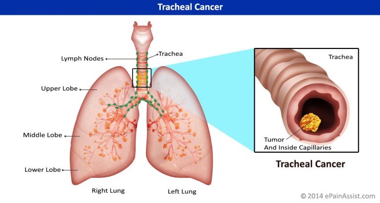 Tracheal Cancer : Causes, Signs, Symptoms, Stages, Grading, Treatment- Surgery, Chemotherapy