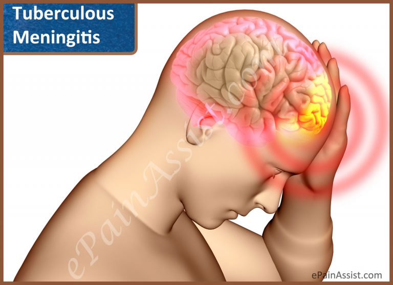 Tuberculous Meningitis: Causes, Symptoms, Diagnosis, Treatment, Prevention, After-Effects.