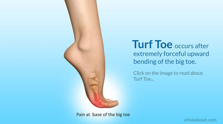 Turf Toe: Causes, Symptoms, Treatment, Recovery Period