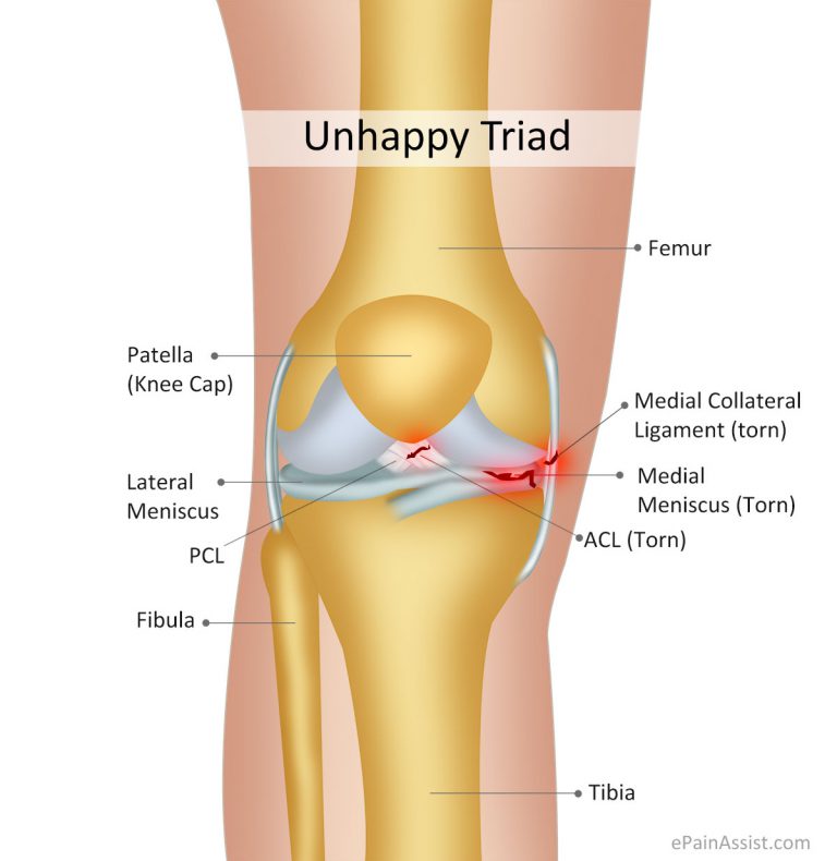 Unhappy Triad or Blown Knee or Terrible Triad: Etiology, Symptoms, Treatment