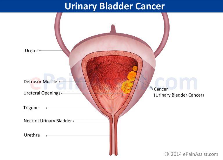 Urinary Bladder Cancer: Types, Symptoms, Stages, Treatment- TUR Surgery, Immunotherapy