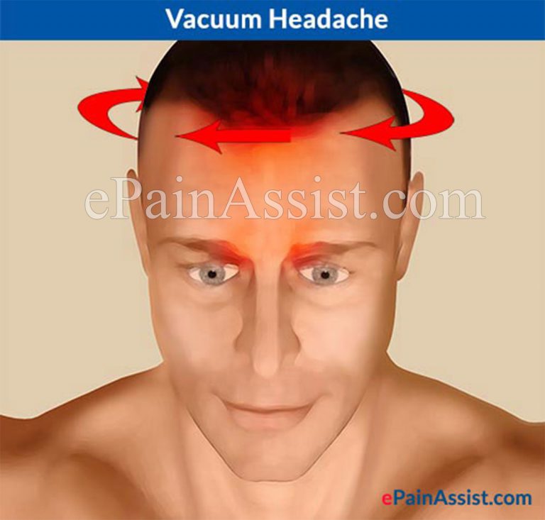 Vacuum Headache: Symptoms, Causes, Treatment, Prevention- Medications, Hydration