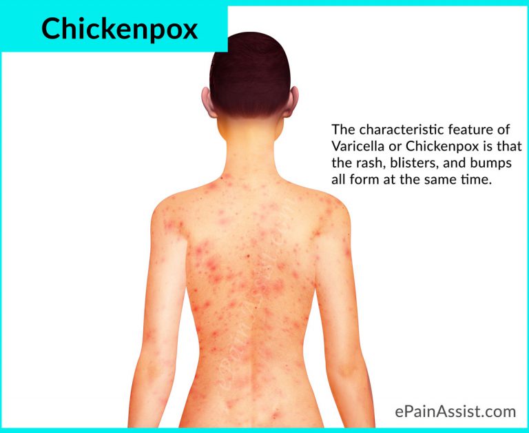 Varicella or Chickenpox: Symptoms, is it Contagious, Treatment, Prevention, Coping Tips