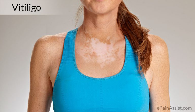 Vitiligo: Types, Causes, Symptoms, Investigations, Treatment, Surgery, Self Measures