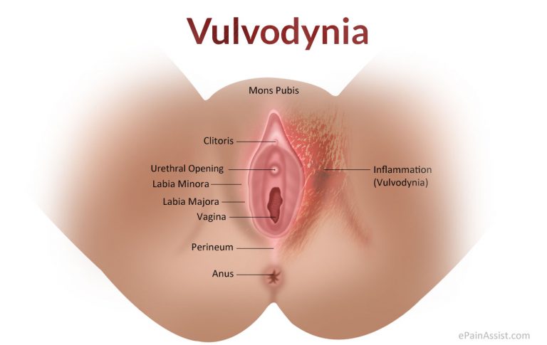 Vulvodynia: Classification, Types, Etiology, Risk Factors, Signs, Symptoms, Treatment, Prognosis