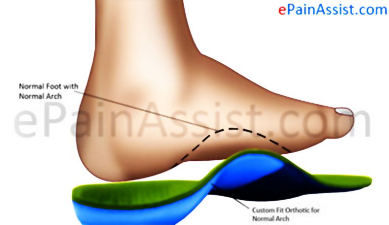 What is Custom Foot Orthotics? What are the Types of Custom Made Foot Orthotics?