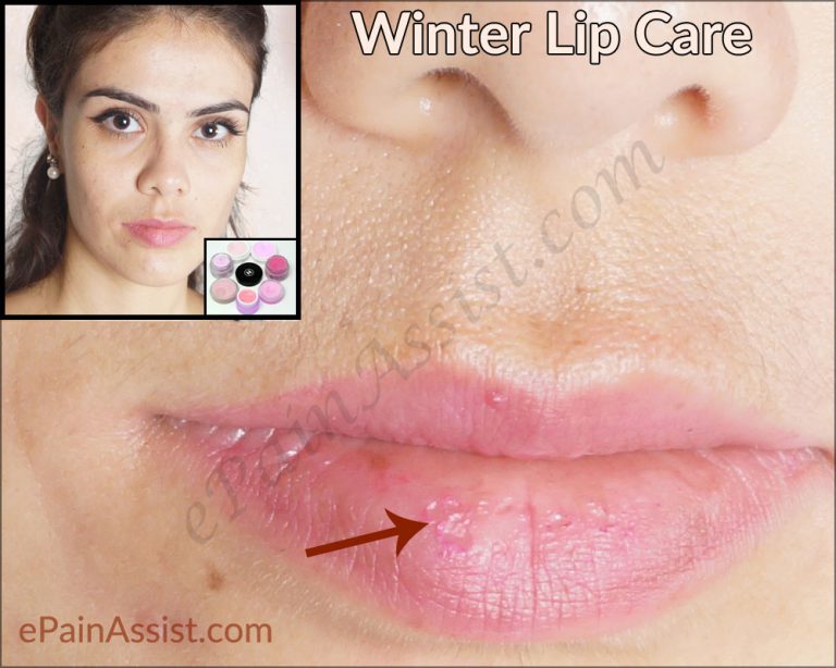 Winter Lip Care: Natural Home Remedies For Chapped Lips