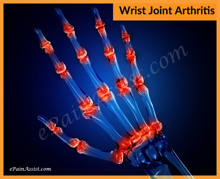 Wrist Joint Arthritis: Symptoms, Causes, Treatment- Medications, NSAIDs, PT, Surgery