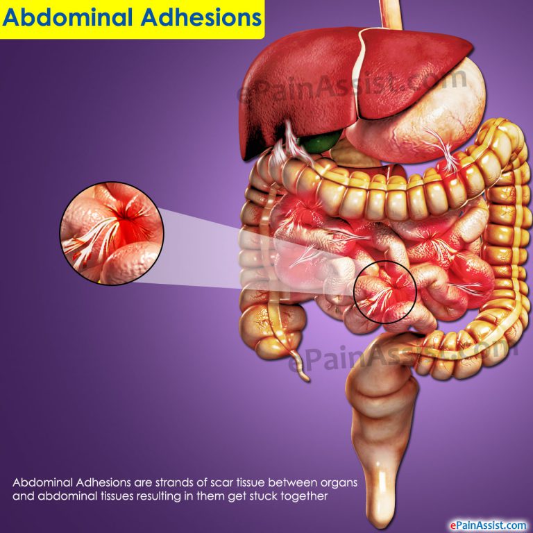 Abdominal Adhesions: Causes, Symptoms, Diagnosis, Treatment, Prevention, Diet
