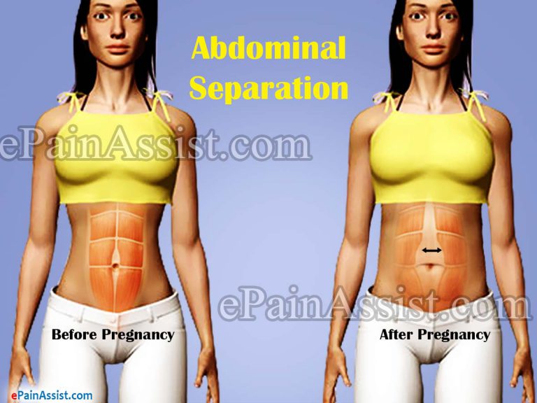 Abdominal Separation: Causes, Symptoms, Treatment, Exercise, Epidemiology