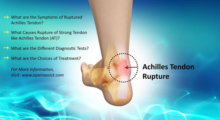 Is Achilles Tendon Rupture a Common Injury|Causes, Symptoms, Treatment, Surgery for Achilles Tendon Rupture
