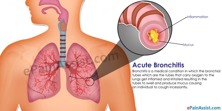 Acute Bronchitis: Causes, Symptoms, Diagnosis, Treatment, Prevention