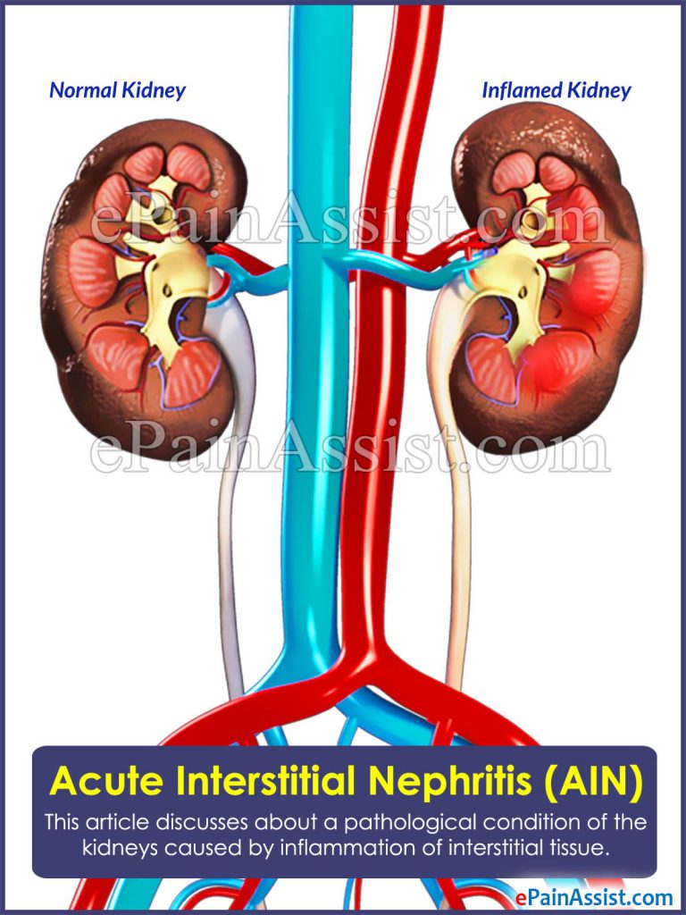 Acute Interstitial Nephritis (AIN): Causes, Risk Factors, Symptoms, Treatment, Prognosis