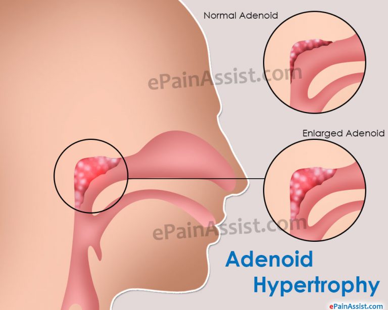 Adenoid Hypertrophy : Causes, Symptoms, Treatment