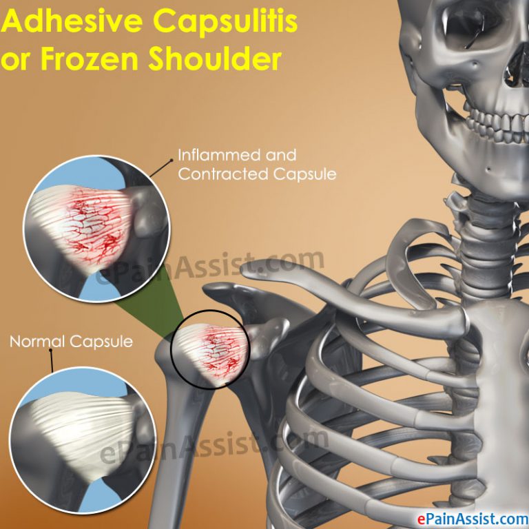 Adhesive Capsulitis or Frozen Shoulder:  Epidemiology, Types, Signs, Symptoms, Causes, Risk Factors, Treatment