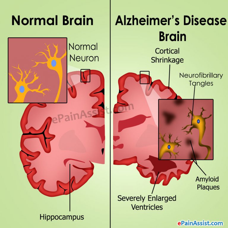 Alzheimer’s Disease: Causes, Stages, Treatment, Prognosis