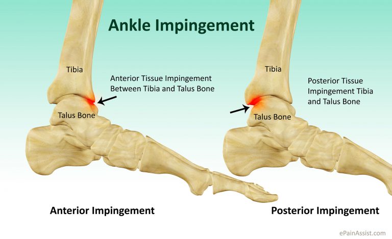 What is Ankle Impingement: Symptoms, Causes, Treatment, Recovery Period, Exercises