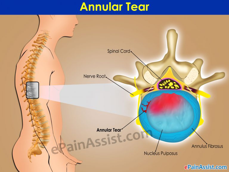Annular Tear: Types, Causes, Signs, Symptoms, Treatment, Healing Time, Exercises