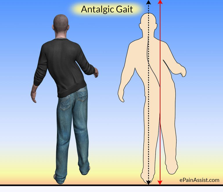 What Can Cause Antalgic Gait and What Are Its Treatment?