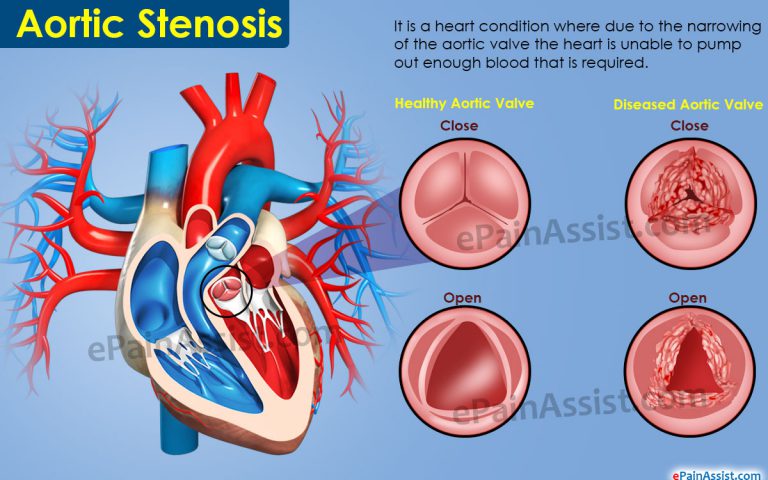 Aortic Stenosis: Causes, Symptoms, Treatment, Prognosis, Pathophysiology