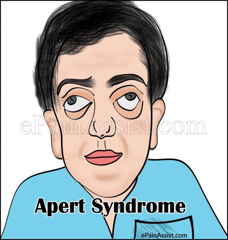 Apert Syndrome: Treatment, Prognosis, Life Expectancy, Causes, Symptoms, Epidemiology