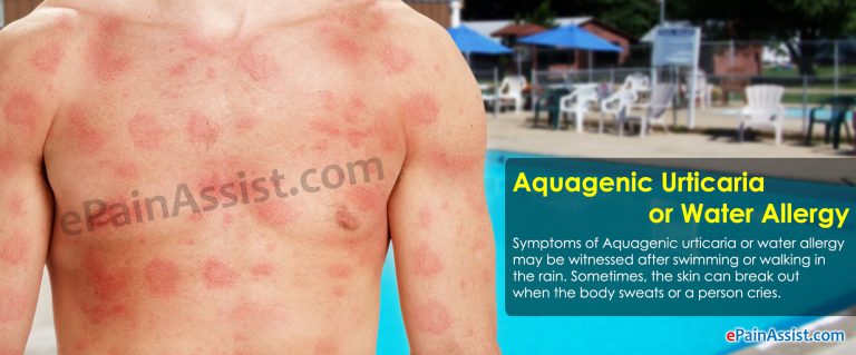 Aquagenic Urticaria or Water Allergy: Causes, Symptoms, Treatment, Risk Factors