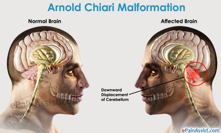 Arnold Chiari Malformation: Causes, Symptoms, Diagnosis, Treatment