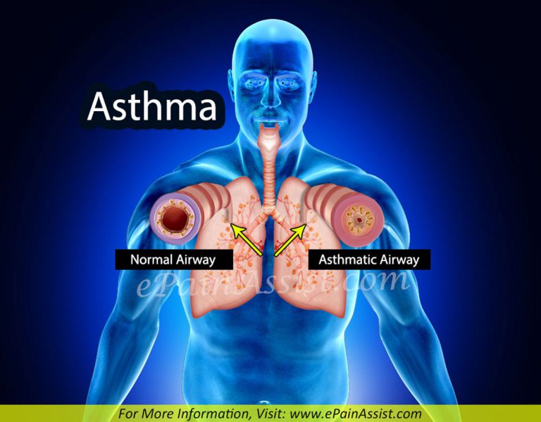 Asthma: Causes, Signs, Symptoms, Diagnosis, Treatment, Home Remedies, Prevention