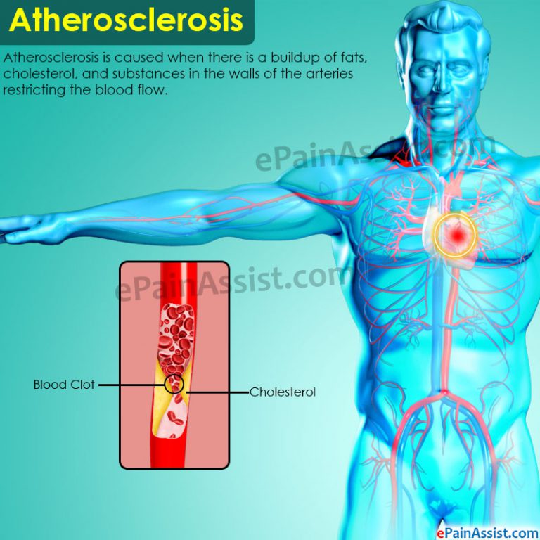 Atherosclerosis or Arteriosclerosis: Causes, Symptoms, Treatment, Prevention, Complications