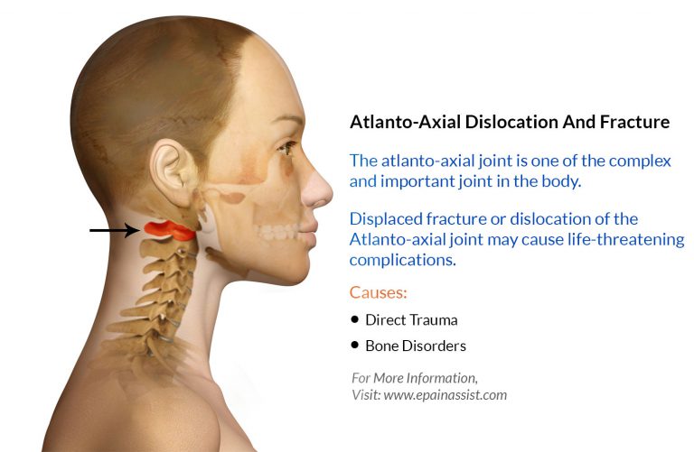 Atlanto-Axial Dislocation And Fracture: Causes, Symptoms, Diagnosis, Treatment, Prognosis