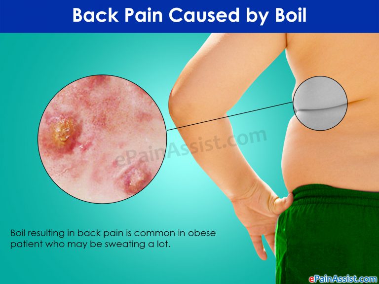 Boil: Back Pain From Infection Of Hair Follicle, Sweat Gland