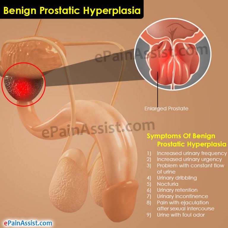 Benign Prostatic Hyperplasia: Causes, Symptoms, Diagnosis, Treatment
