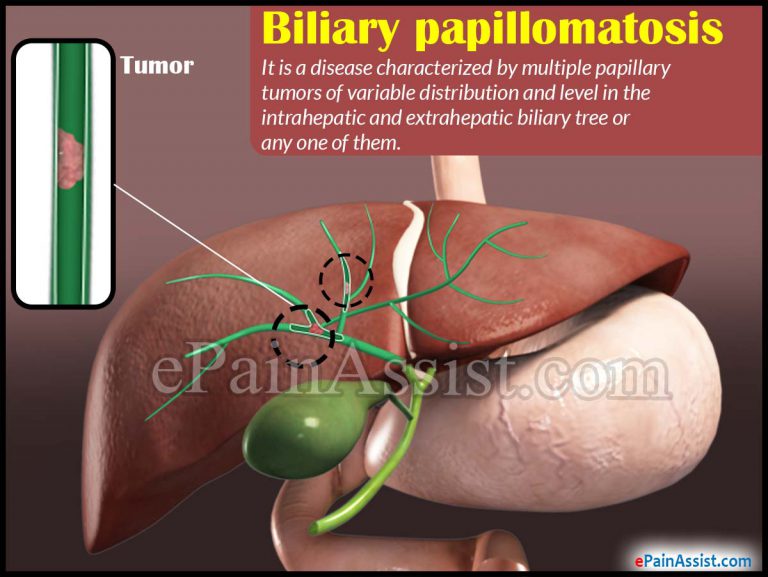 Biliary Papillomatosis: Symptoms, Causes, Treatment, Epidemiology, Diagnosis