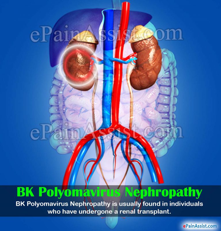 BK Polyomavirus Nephropathy: Causes, Symptoms, Diagnosis, Treatment