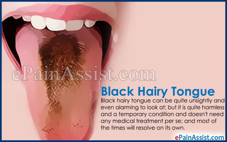 Black Hairy Tongue: Causes, Symptoms, Treatment, Home Remedies