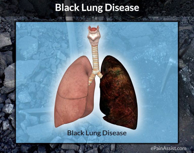 Pneumoconiosis or Black Lung Disease: Symptoms, Diagnosis, Treatment, Prevention, Who is at   Risk