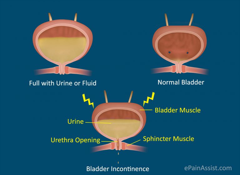 Bladder Sphincter Dyssynergia or Neurogenic Detrusor Overactivity: Causes, Symptoms, Treatment