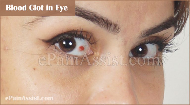 Blood Clot in Eye: Causes, Symptoms, Treatments, Home Remedies