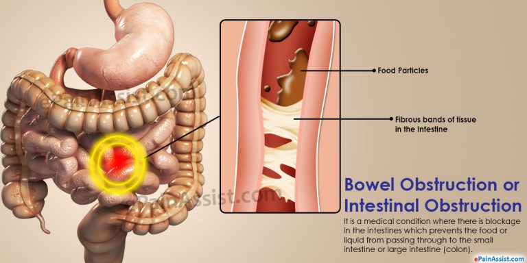 Bowel Obstruction or Intestinal Obstruction: Causes, Risk Factors, Symptoms, Signs, Treatment, Investigations
